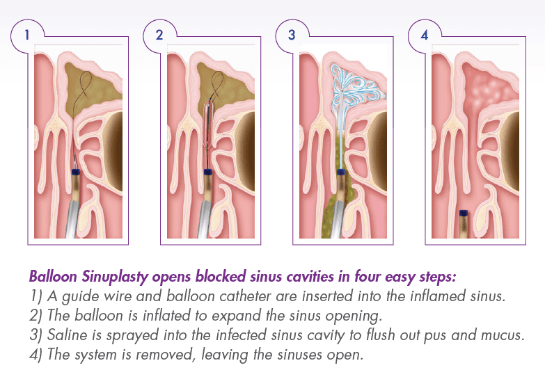 Balloon sinuplasty illustration